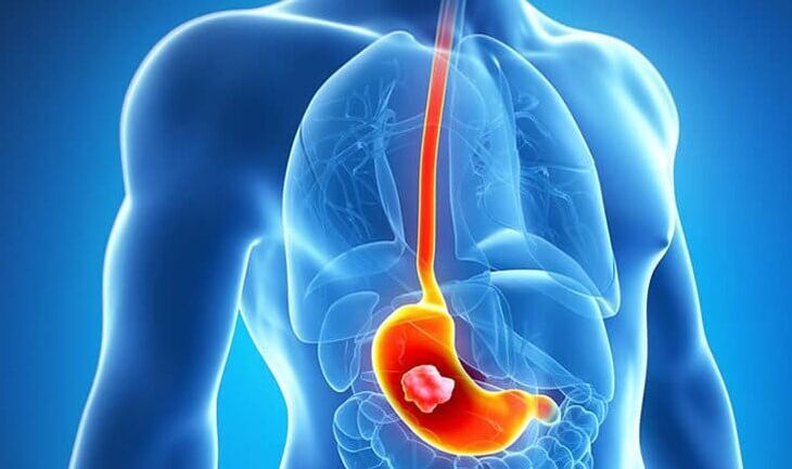 Daca ai ulcer gastric, este contraindicat sa urmezi dieta Dukan.